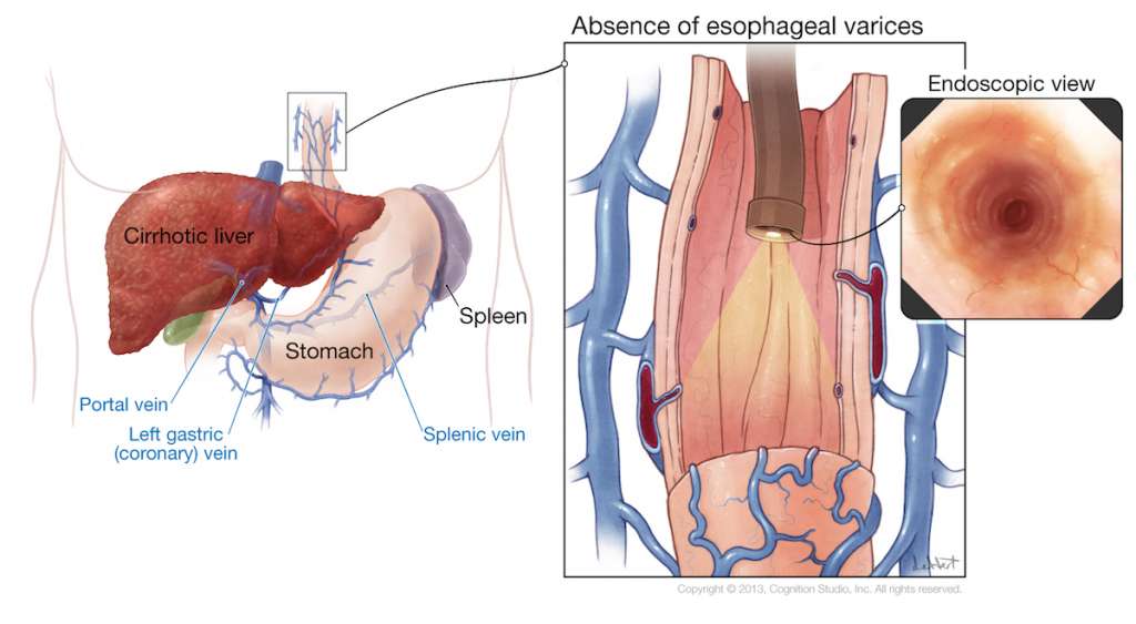 endoscopic-variceal-banding-dr-indraneel-chakrabarty-md